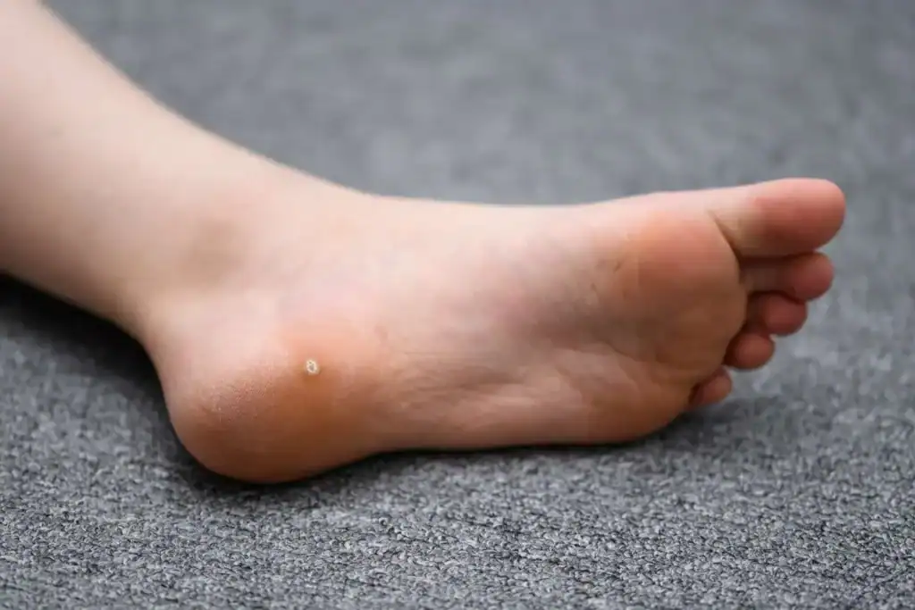Cryotherapy For Warts And Also Verrucas 2 Image of verruca on the bottom of the foot that able to be treated with Cryotherapy Bexhill