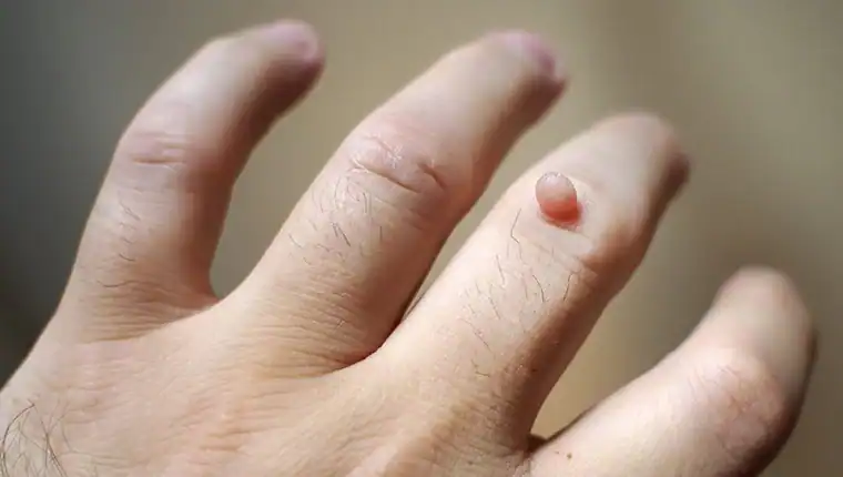Image of blemish that Cryotherapy Bexhill can remove with Lipo 360.