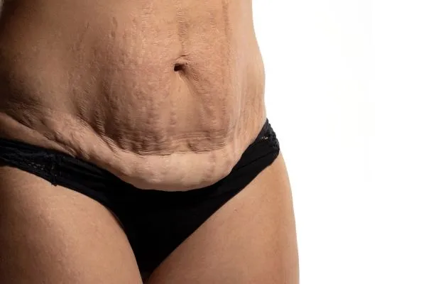 The science behind skin tightening Bexhill picture of a woman's sagging skin on the stomach